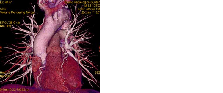 Angio TAC aorta addominale