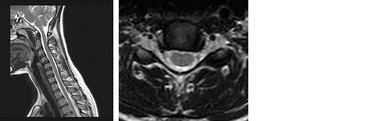 Colonna cervicale RM