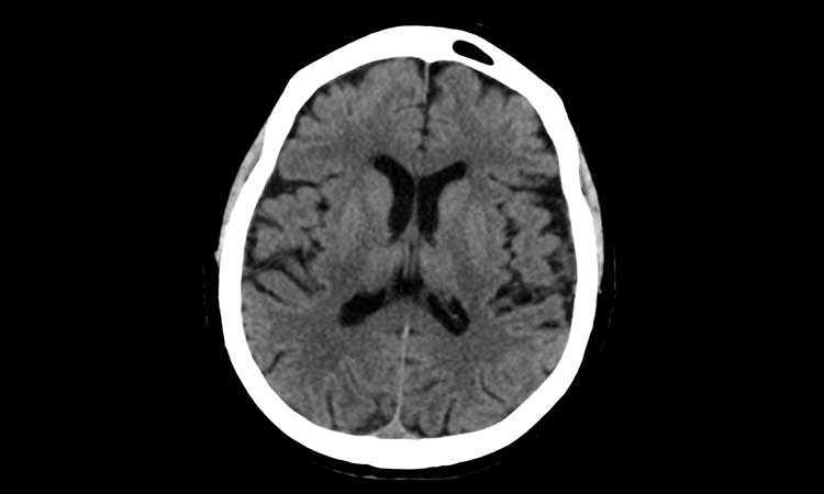 TC Cranio