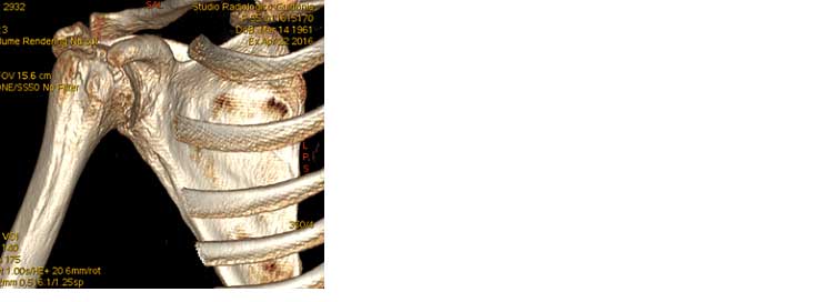 TC-TAC Spalla TC-TAC Spalla